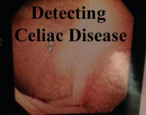 detecting-celiac